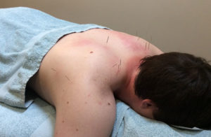 dry needling ringwood & watsonia bodyworkx