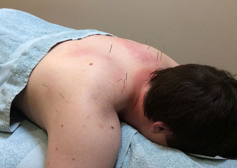 dry-needling-2-bodyworkx-ringwood-eltham dry needling treatment Ringwood and Eltham