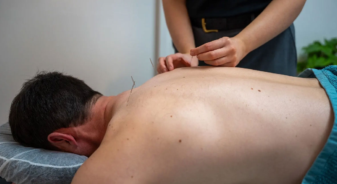 Accupunture-bodyworkx-clinic-Ringwood accupuncture and dry needling at Bodyworkx