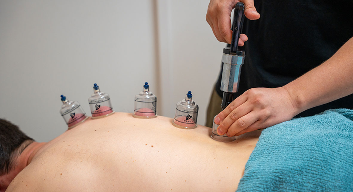 cupping-bodyworkx-clinic-Ringwood cupping treatment at Bodyworkx Clinic